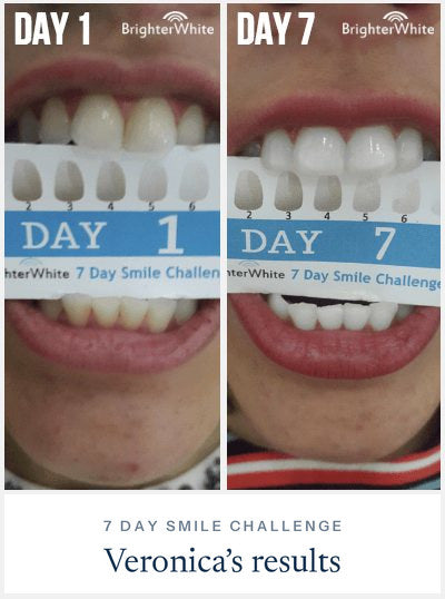 Veronica - day 1 vs day 7 result, 7 Day Smile Challenge