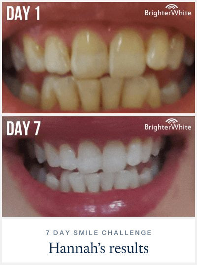 Hannah - day 1 vs day 7 result, 7 Day Smile Challenge