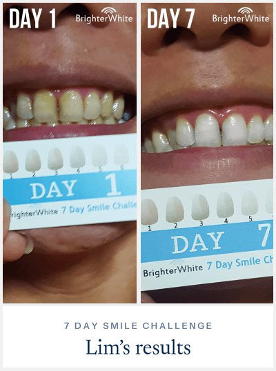 Lim - day 1 vs day 7 result, 7 Day Smile Challenge