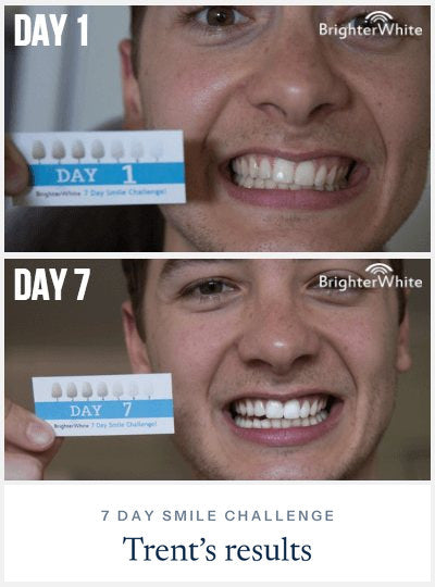 Trent - day 1 vs day 7 result, 7 Day Smile Challenge