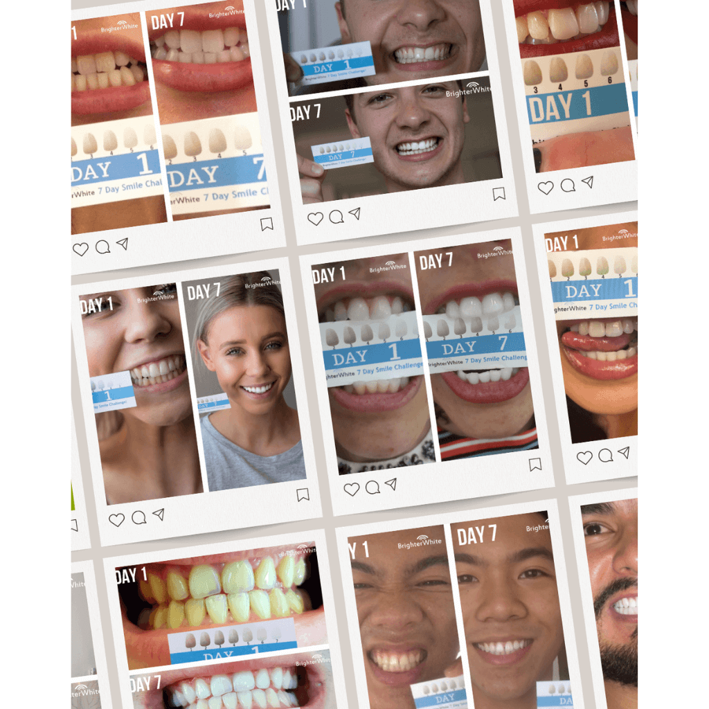 BrighterWhite teeth whitening gel 6 pack shown with the full at-home whitening kit