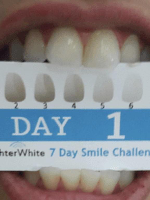 Customer's teeth on day 1, before whitening, next to a shade guide