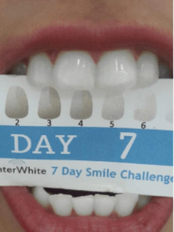 The same customer's teeth on day 7, next to a shade guide